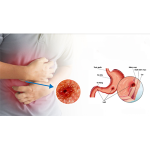 Thủng dạ dày – tá tràng